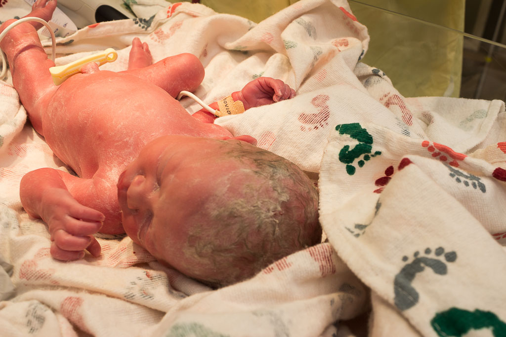 Elanor and Rose: a Twin Birth Story Karin Rambo of Truncationblog.com shares her twin birth story